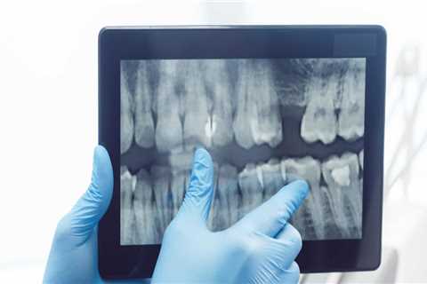 Are dental x rays needed every 6 months?