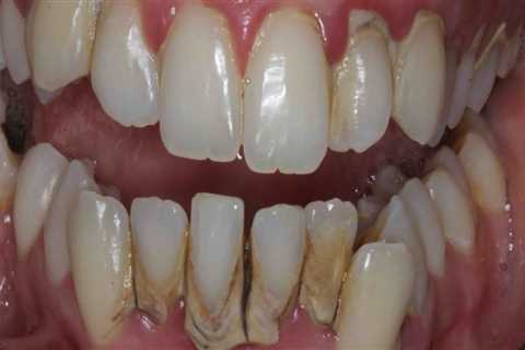 Can veneers cause problems?