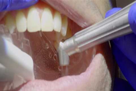 How do you keep veneers from falling off?