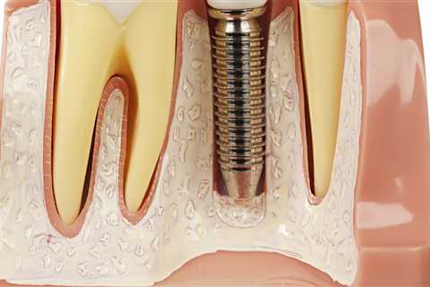 What material are dental implant teeth made of?