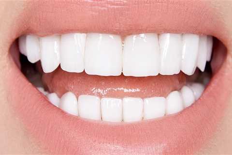 How many veneers top and bottom?