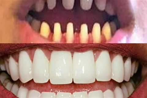 What happens to the teeth under veneers?