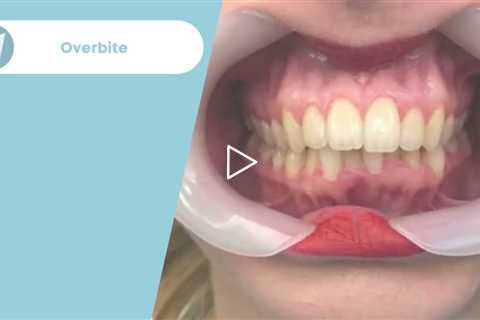 Overbite Treatment Before / After - Forest & Ray - Dentists, Orthodontists, Implant Surgeons