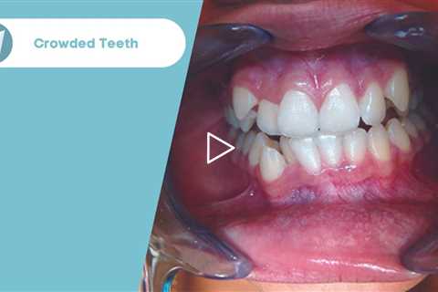 Crowded Teeth Treatment Before / After - Forest & Ray - Dentists, Orthodontists, Implant Surgeons