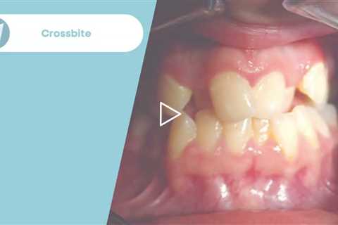 Crossbite Treatment Before / After - Forest & Ray - Dentists, Orthodontists, Implant Surgeons