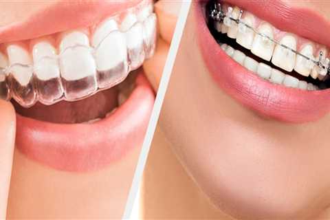 Are clear aligners cheaper than braces?