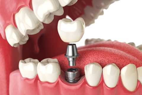 Three reasons why dental implants are important - Vents Magazine