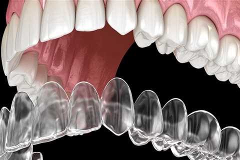 Why are clear aligners so expensive?