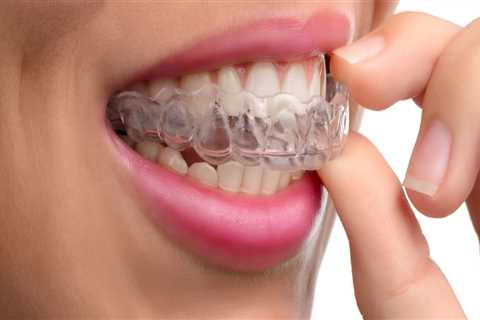 Are clear aligners permanent?