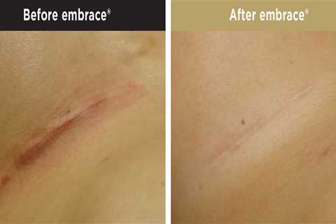 Do You Have Scars After Breast Reduction?