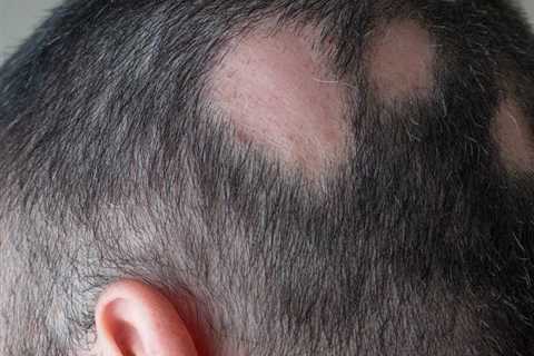 How Can Women Use Just For Men Hair Regrowth?