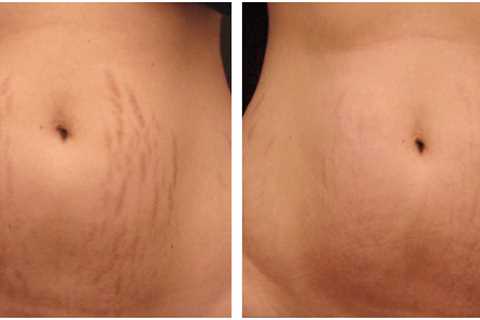 How Much Does Laser Therapy For Stretch Marks Cost?