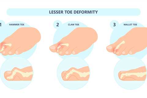Have Crooked Toes? Here's How To Get Rid of Them for Good