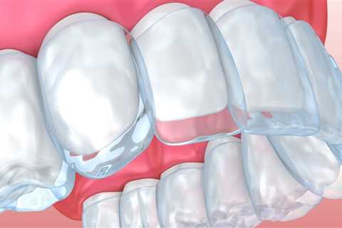 Will aligners work on crowded teeth?