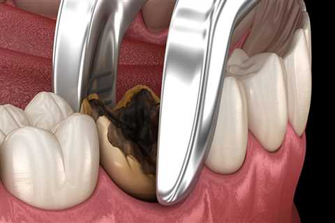 How long will the pain last after oral surgery?