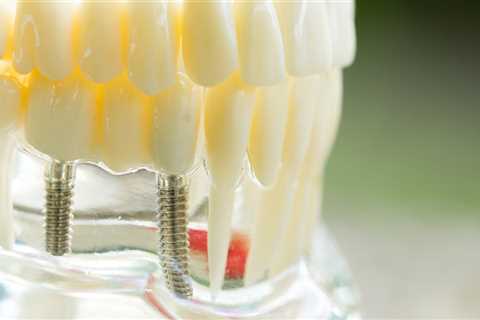 The Process For Getting Dental Implants In McGregor