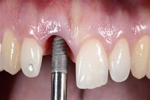 What To Expect When Getting Dental Implants In Ellsworth