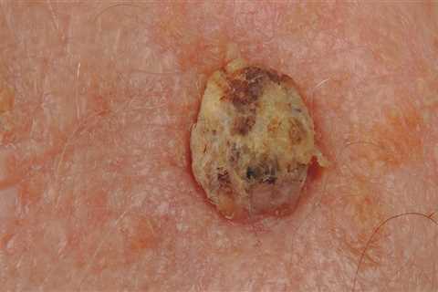 Understanding Squamous Cell Carcinoma: A Skin Cancer Overview