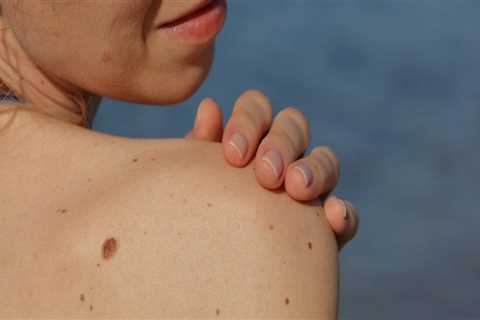 Treating Melanoma: What You Need to Know