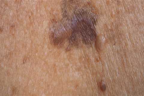 Understanding the Risk Factors for Melanoma Skin Cancer