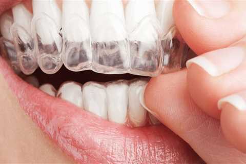 How Often Should You Visit the Dentist for Invisalign Treatment? A Guide