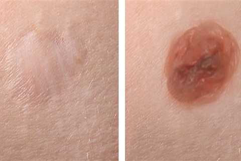 Monitoring for Signs of Infection After Mole Removal