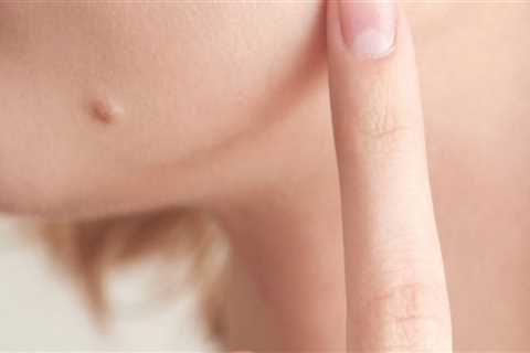 Affordable Mole Removal: Discounts and Payment Plans Explained