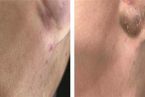 Cryosurgery: An Overview of Mole Removal Procedures