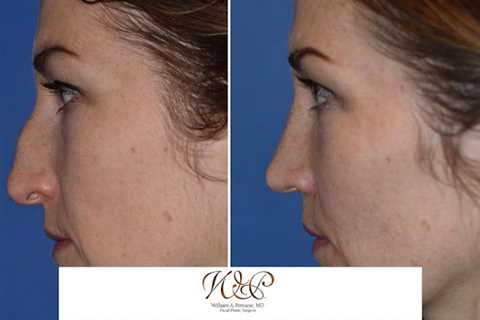 The Portland Center for Facial Plastic Surgery : Rhinoplasty, Facelift Surgery