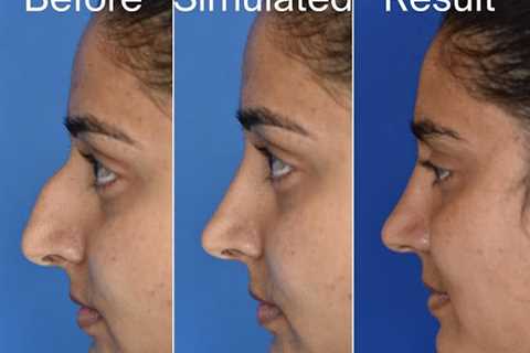 The Seattle Rhinoplasty Center