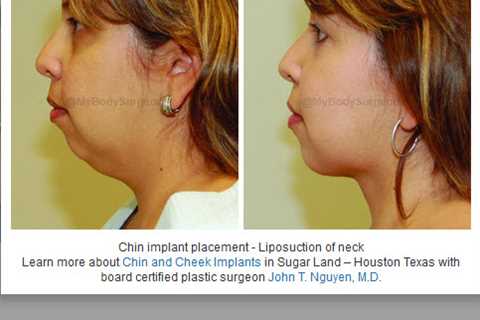 Sugar Land Plastic Surgery