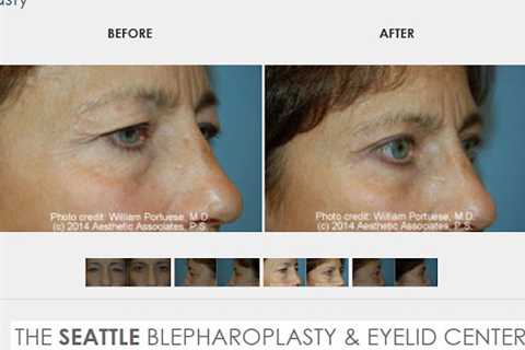 The Seattle Eyelid & Blepharoplasty Center