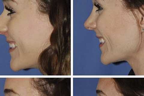 Benefits Of Rhinoplasty