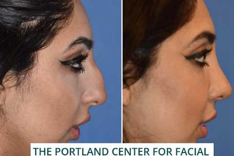 The Portland Center for Facial Plastic Surgery : Rhinoplasty, Facelift Surgery