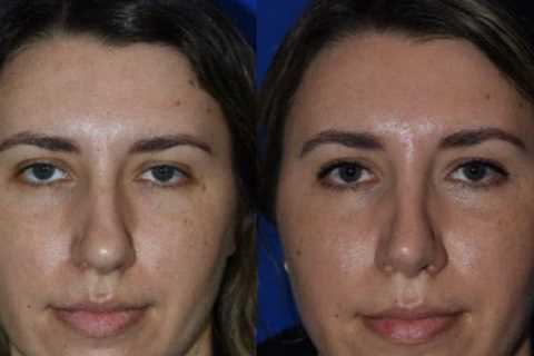 The Portland Center for Facial Plastic Surgery : Rhinoplasty, Facelift Surgery