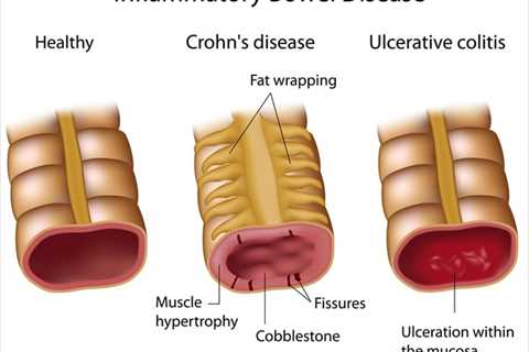 Intermittent Fasting and Crohn's Disease