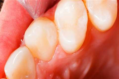 Do minor cavities need to be filled?