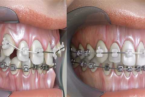 How long should braces stay on teeth?