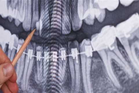 What can dental x-rays detect?