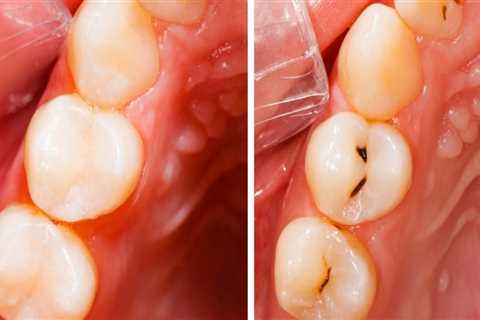 Are fillings considered restorations?