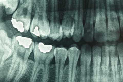 What is dental x ray?