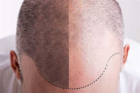 Some Known Factual Statements About Hair Transplant In Indore