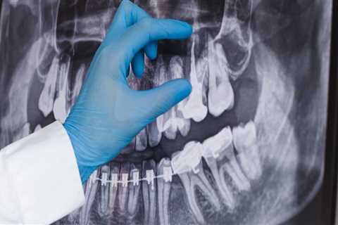 Understanding The Role Of Dental X-Rays In Treating Temporomandibular Joint Disorders In Spring, TX