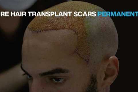 The smart Trick of Hair Transplant In Indore That Nobody is Talking About