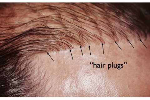 Unknown Facts About Hair Transplant In Indore