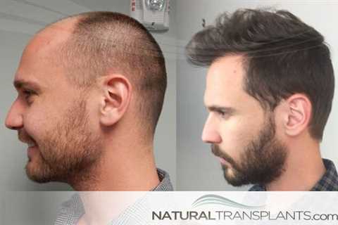 Top Guidelines Of Hair Transplant In Indore