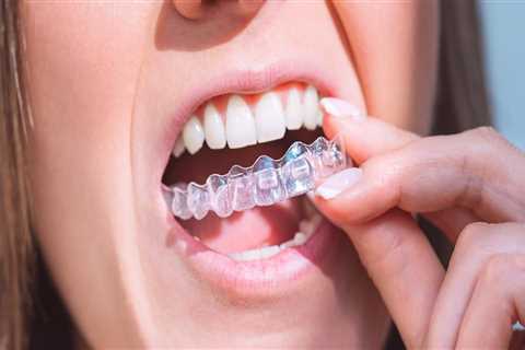 What Factors Determine the Cost of Invisalign Treatments?