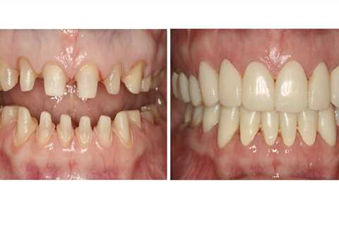 What are the best teeth restoration?