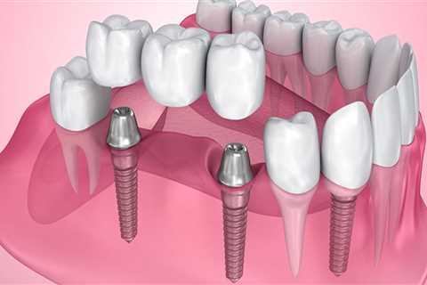 Why dental implants are important?