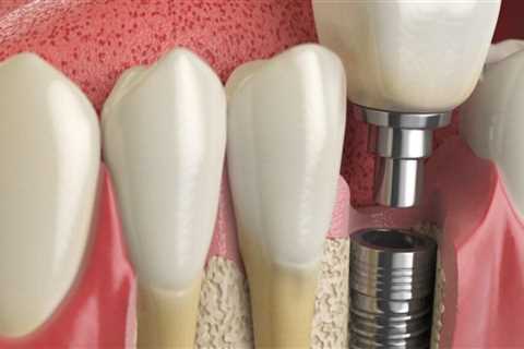 Which dental implants last the longest?